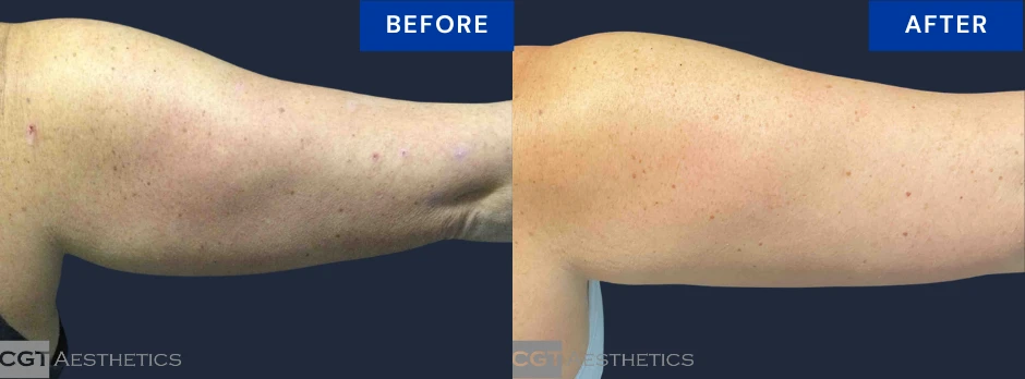 CoolSculpting Elite before and after result for stubborn upper arm fat at CGT Aesthetics
