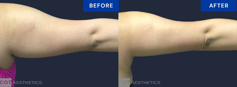 CoolSculpting Elite upper arms before and after result at CGT Aesthetics