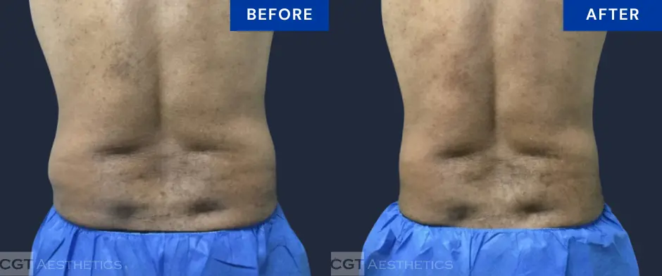 CoolSculpting flanks before and after at CGT Aesthetics in Evergreen Park and Westmont