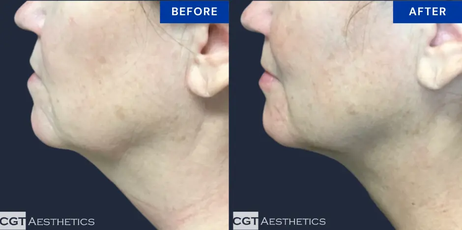 CoolSculpting submental fat before and after at CGT Aesthetics in Evergreen Park and Westmont