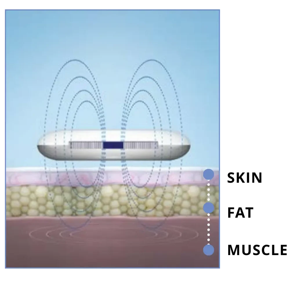 cooltone-muscle-stimulation-technology-diagram-cgt-aesthetics