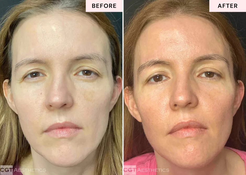 Before and after Helix DEKA Fusion CO2 laser resurfacing at CGT Aesthetics showing facial skin texture and tone changes.