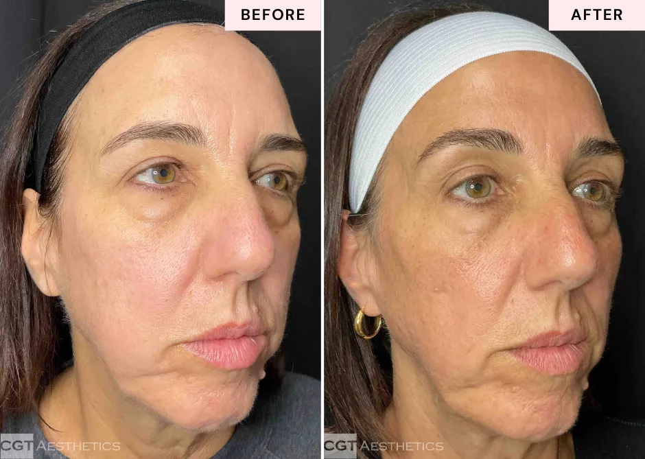 Before and after DEKA Fusion CO2 laser resurfacing at CGT Aesthetics showing changes in facial skin texture and tone.
