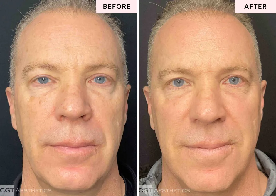 Before and after DEKA Fusion CO2 laser treatment at CGT Aesthetics showing changes in fine lines and overall skin texture.