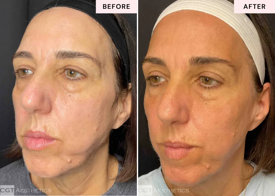 Before and after DEKA Fusion laser resurfacing at CGT Aesthetics showing changes in uneven skin tone and texture.