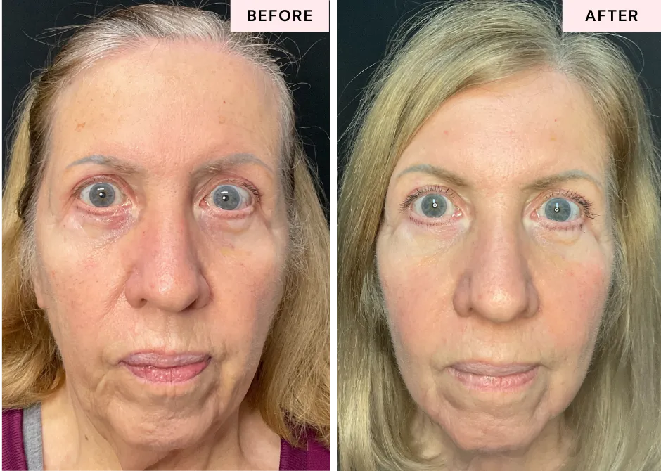Before and after Helix DEKA Fusion laser resurfacing at CGT Aesthetics showing changes in skin texture, tone, and visible signs of aging.