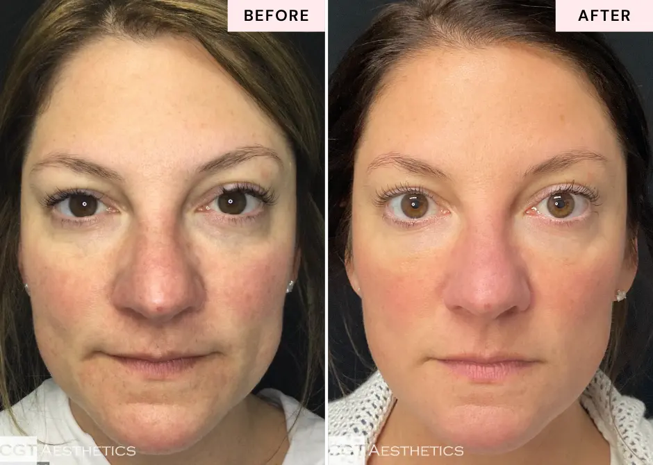 Before and after DiamondGlow facial treatment showing improved skin radiance and texture for a CGT Aesthetics skincare membership patient in Evergreen Park and Westmont, IL