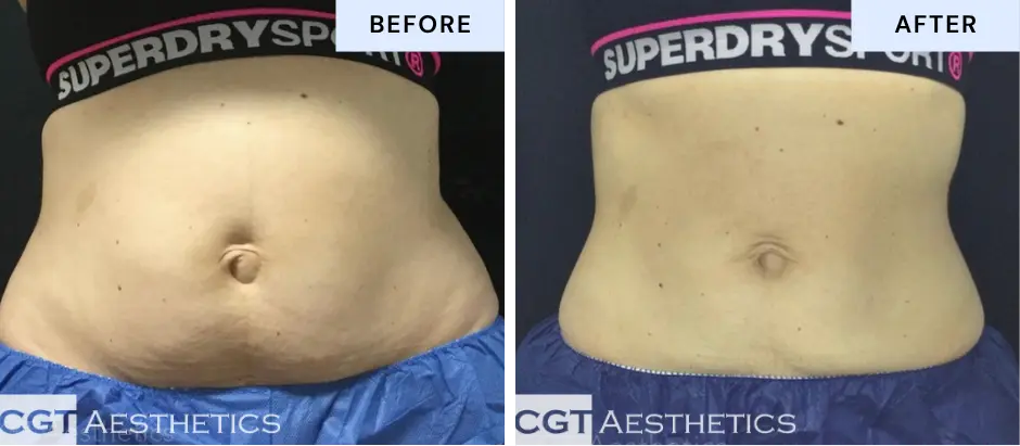 Emsculpt NEO abdomen toning before and after at CGT Aesthetics in Evergreen Park and Westmont