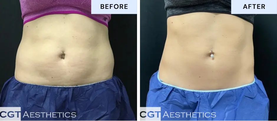 Emsculpt NEO abdomen toning before and after at CGT Aesthetics in Evergreen Park and Westmont