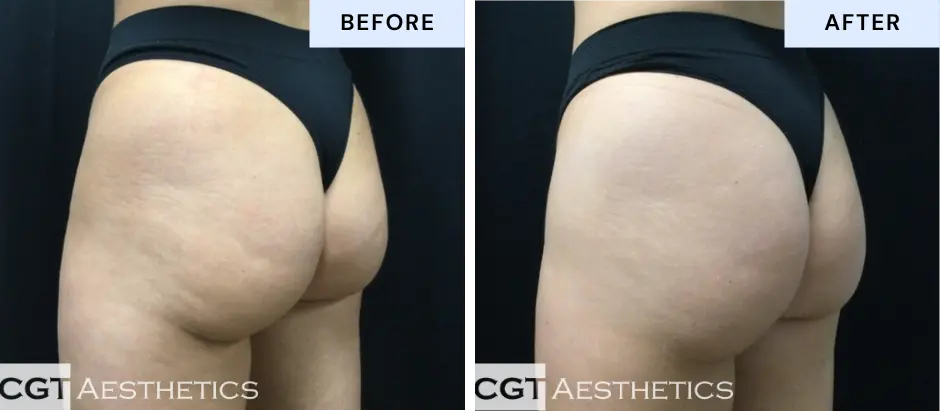 Emsculpt NEO glutes before and after at CGT Aesthetics in Evergreen Park and Westmont