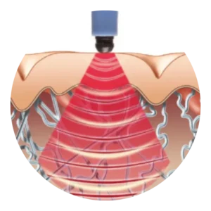 Illustration showing collagen and elastin support beneath the skin during Exilis Ultra 360 treatments at CGT Aesthetics