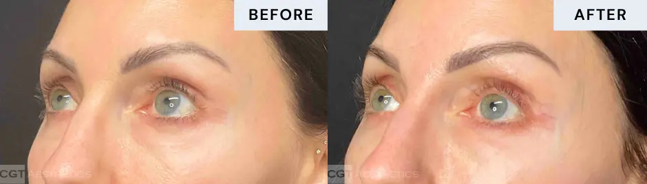 exilis-ultra-360-eye-rejuvenation-before-after-04 Before and after Exilis Ultra 360 treatment around the eyes at CGT Aesthetics