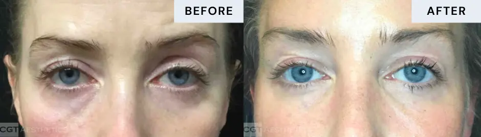 exilis-ultra-360-eyes-before-after-cgt-aesthetics-01 Exilis Ultra 360 eye-area skin tightening before and after at CGT Aesthetics