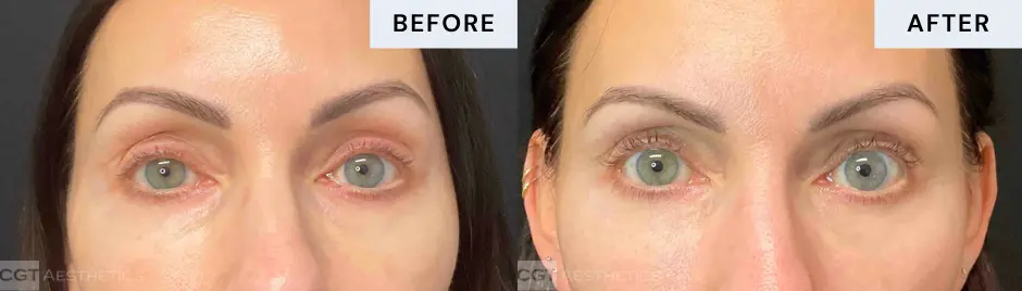 exilis-ultra-360-eyes-before-after-cgt-aesthetics-02 Before and after Exilis Ultra 360 eye-area rejuvenation and skin tightening at CGT Aesthetics