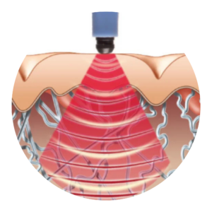 Illustration showing Exilis Ultra 360 radiofrequency energy heating the deeper layers of the skin.