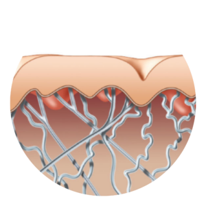 Illustration of loose skin and collagen fibers before an Exilis Ultra 360 treatment.