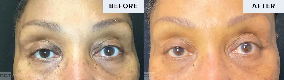 exilis-ultra-360-under-eye-skin-tightening-before-after-03 Exilis Ultra 360 under-eye skin tightening before and after treatment at CGT Aesthetics