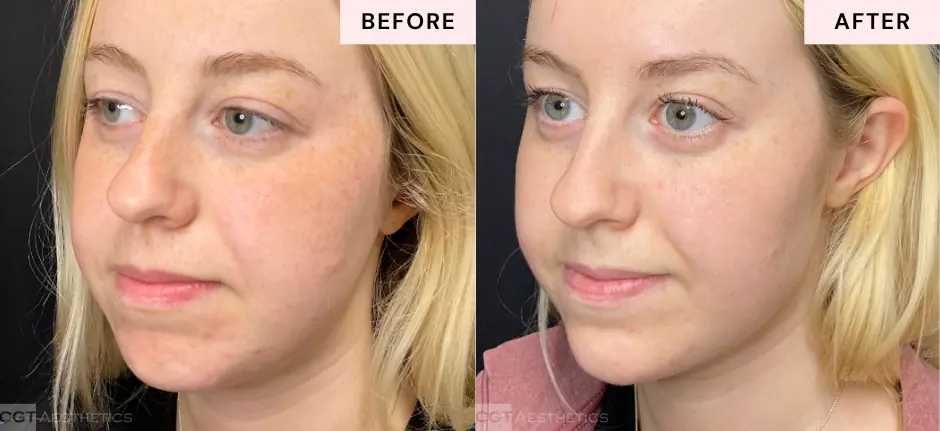 Facial balancing filler before and after for chin, jawline, and cheeks at CGT Aesthetics in Evergreen Park and Westmont