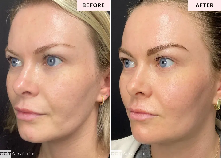 Facial before and after results showing brighter smoother looking skin at CGT Aesthetics in Evergreen Park and Westmont IL