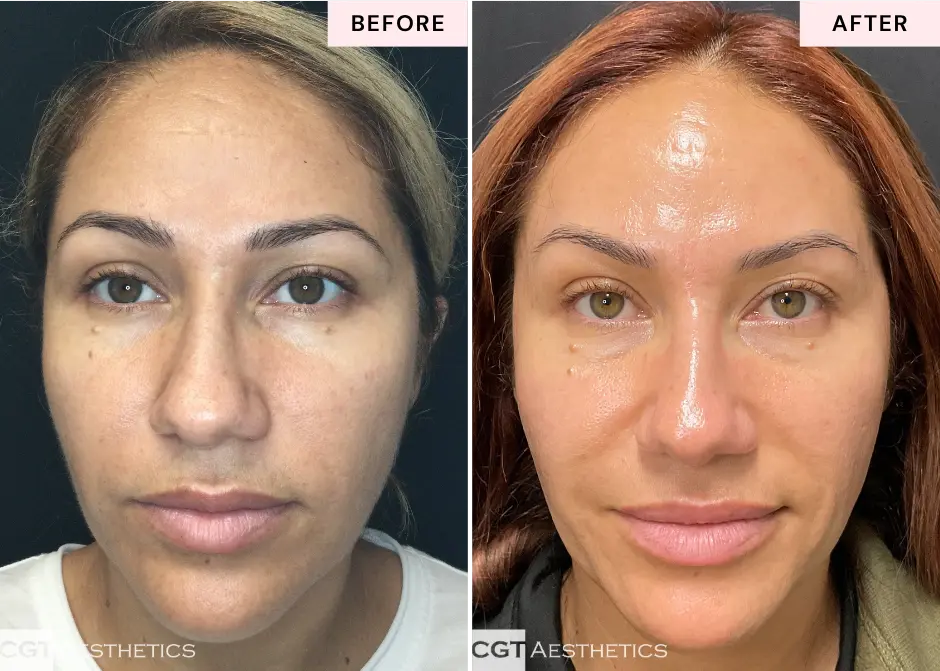 Before and after skincare membership treatment showing brighter, more radiant-looking skin at CGT Aesthetics in Evergreen Park and Westmont, Illinois