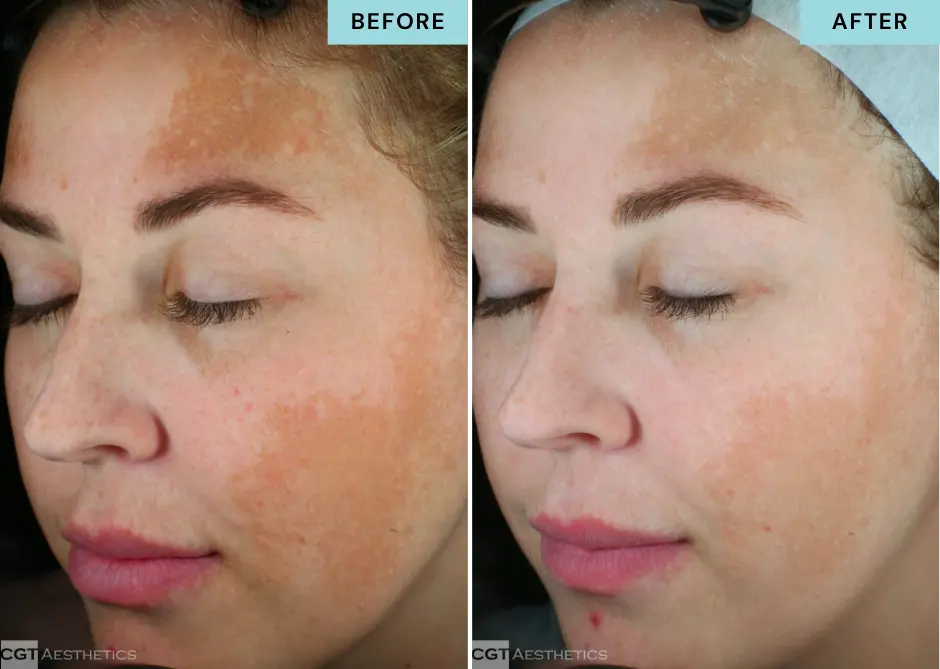 glacial-rx-pigmentation-skin-tone-before-after Before and after Glacial Rx facial treatment showing improvement in uneven pigmentation and skin tone