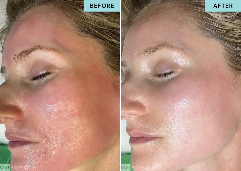 glacial-rx-redness-reduction-before-after Before and after Glacial Rx facial treatment showing improvement in facial redness and inflammation at CGT Aesthetics