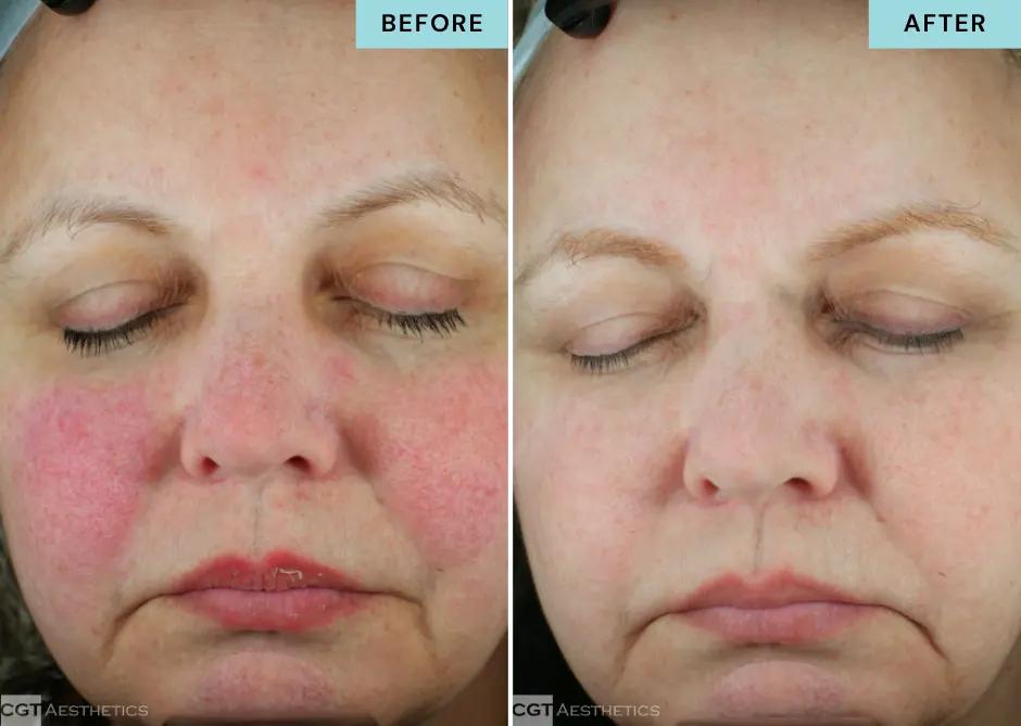 glacial-rx-rosacea-sensitive-skin-before-after Before and after Glacial Rx facial treatment for rosacea and sensitive skin redness reduction