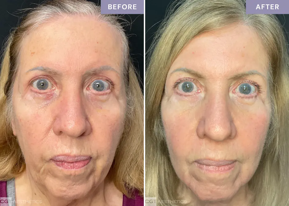 helix-deka-co2-laser-before-and-after-cgt-aesthetics
