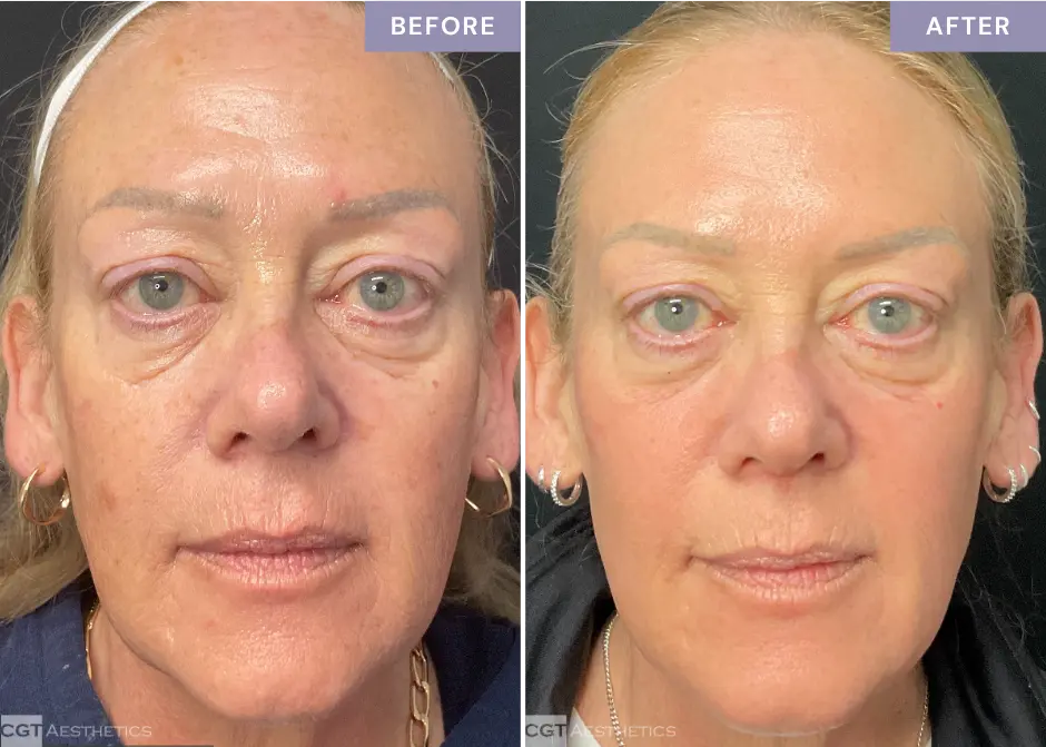 helix-deka-co2-laser-before-and-after-chicago-suburbs