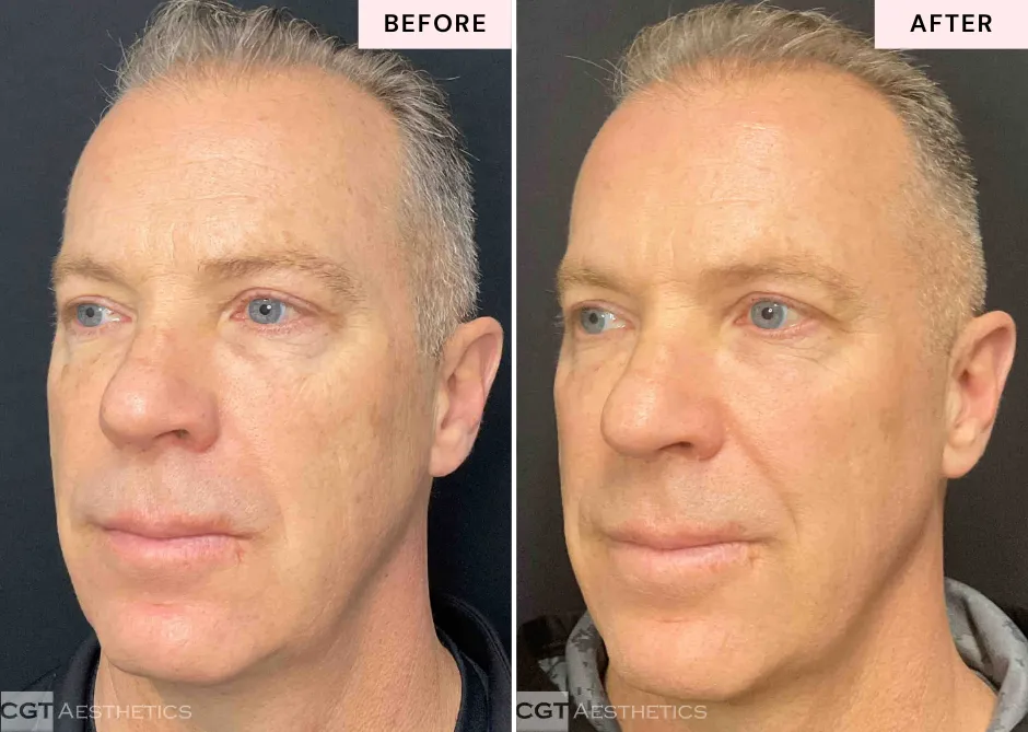 Before and after DEKA Fusion CO2 resurfacing at CGT Aesthetics showing changes in facial skin texture and visible signs of aging.