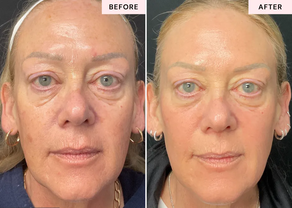 Before and after DEKA Fusion laser treatment at CGT Aesthetics showing facial skin rejuvenation and changes in texture and tone.