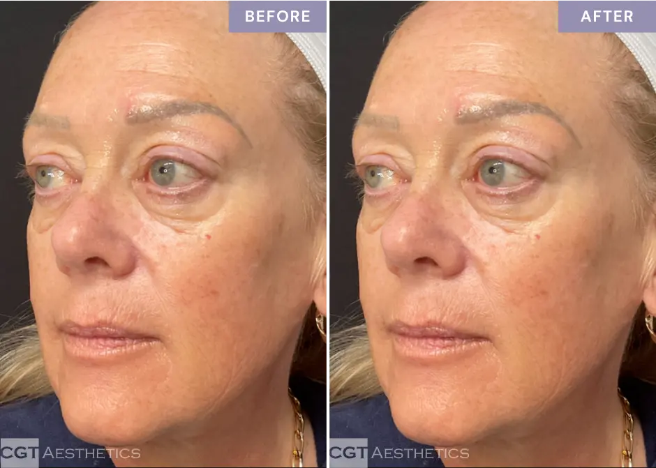 helix-fusion-co2-before-after-cgt-aesthetics Helix Fusion CO2 before and after skin resurfacing treatment at CGT Aesthetics in Evergreen Park and Westmont