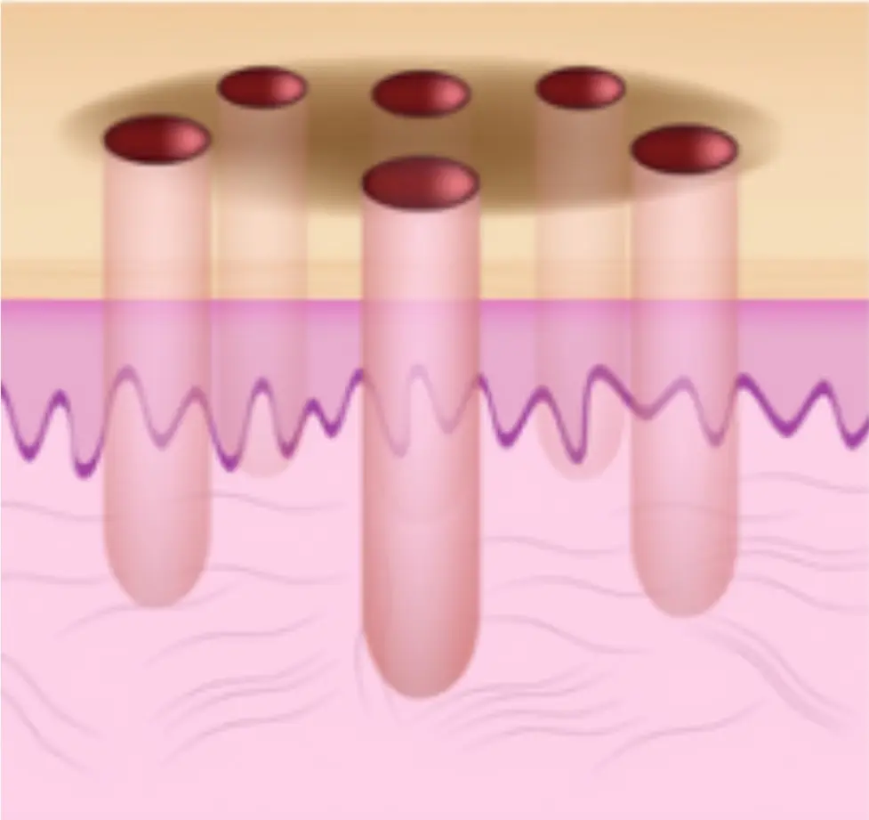 how-1540-resurfacing-laser-works-cgt-aesthetics