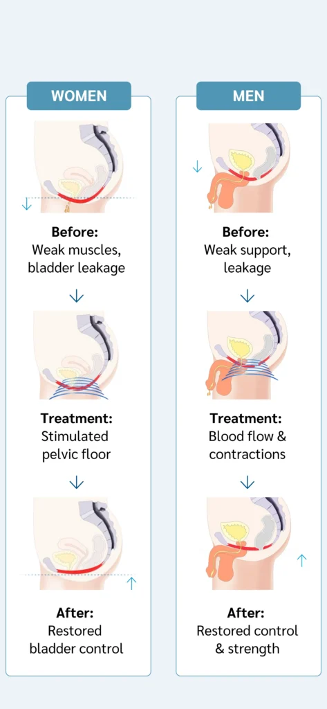 how-emsella-works-evergreen-park-westmont-il How Emsella works to strengthen pelvic floor muscles for men and women in Evergreen Park and Westmont IL