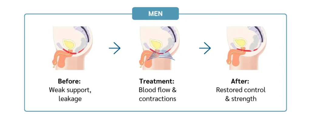 how-emsella-works-men-evergreen-park-westmont-il How Emsella works to strengthen pelvic floor muscles for men in Evergreen Park and Westmont IL
