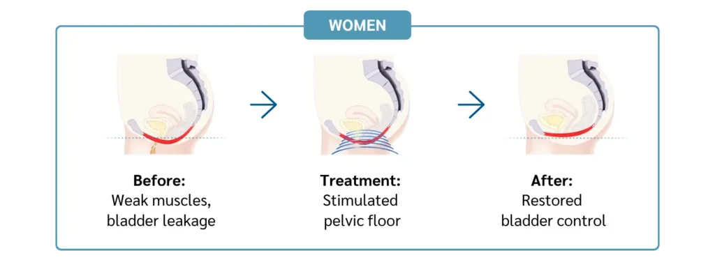 how-emsella-works-women-evergreen-park-westmont-il How Emsella works to strengthen pelvic floor muscles for women in Evergreen Park and Westmont IL