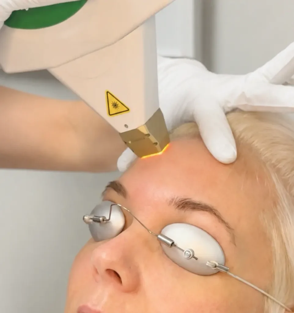 ipl-photofacial-laser-treatment-evergreen-park-westmont-cgt-aesthetics