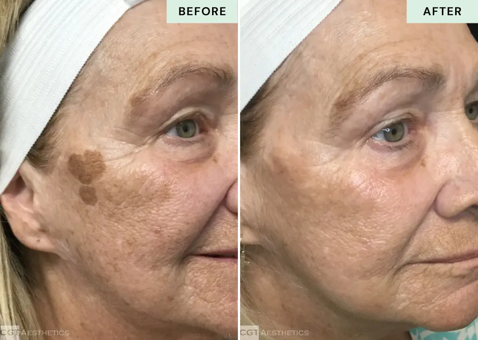 ipl-photofacial-pigmentation-before-after-cgt-aesthetics-westmont