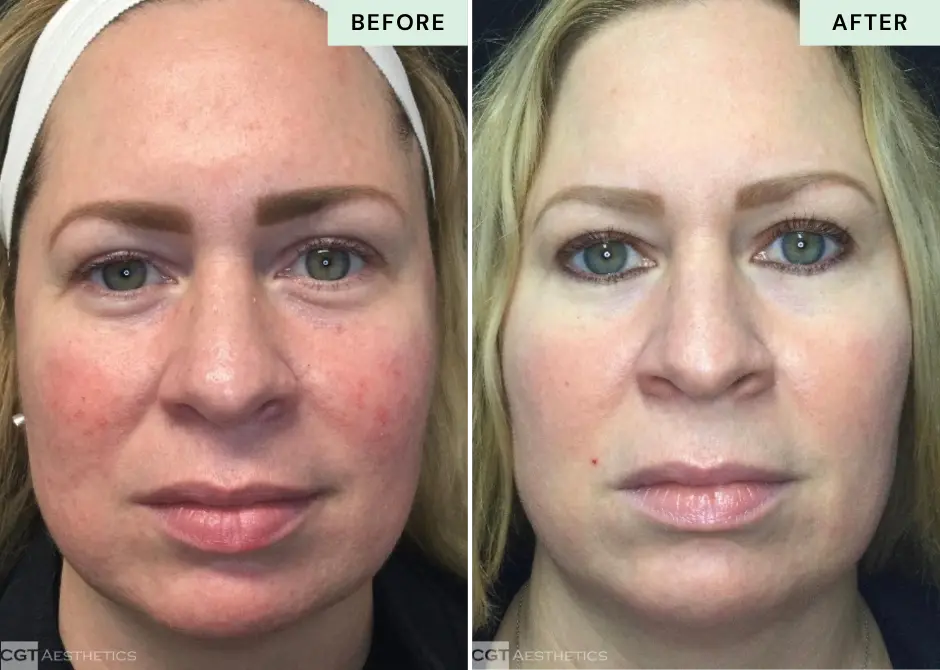 ipl-photofacial-rosacea-redness-before-after-cgt-aesthetics