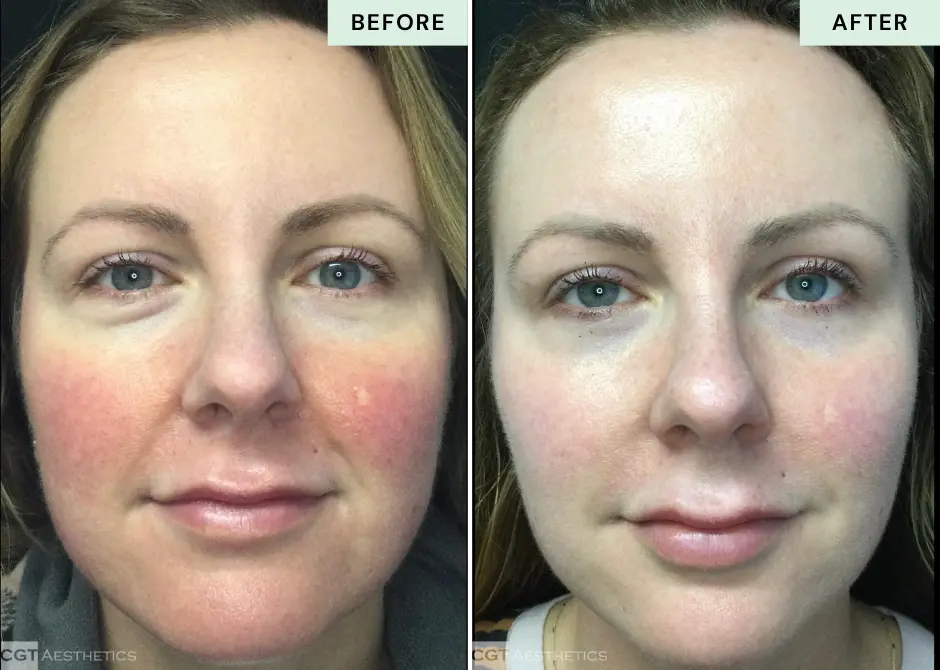 ipl-photofacial-rosacea-redness-before-after-cgt-aesthetics-westmont