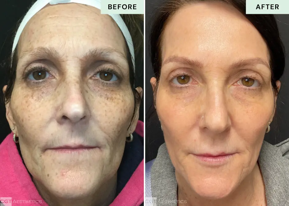 ipl-photofacial-sun-damage-before-after-cgt-aesthetics