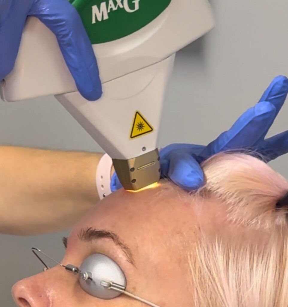 IPL photofacial treatment for sun damage and redness at CGT Aesthetics in Evergreen Park and Westmont