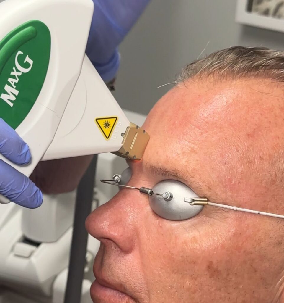 Provider performing IPL photofacial treatment at CGT Aesthetics in Evergreen Park and Westmont