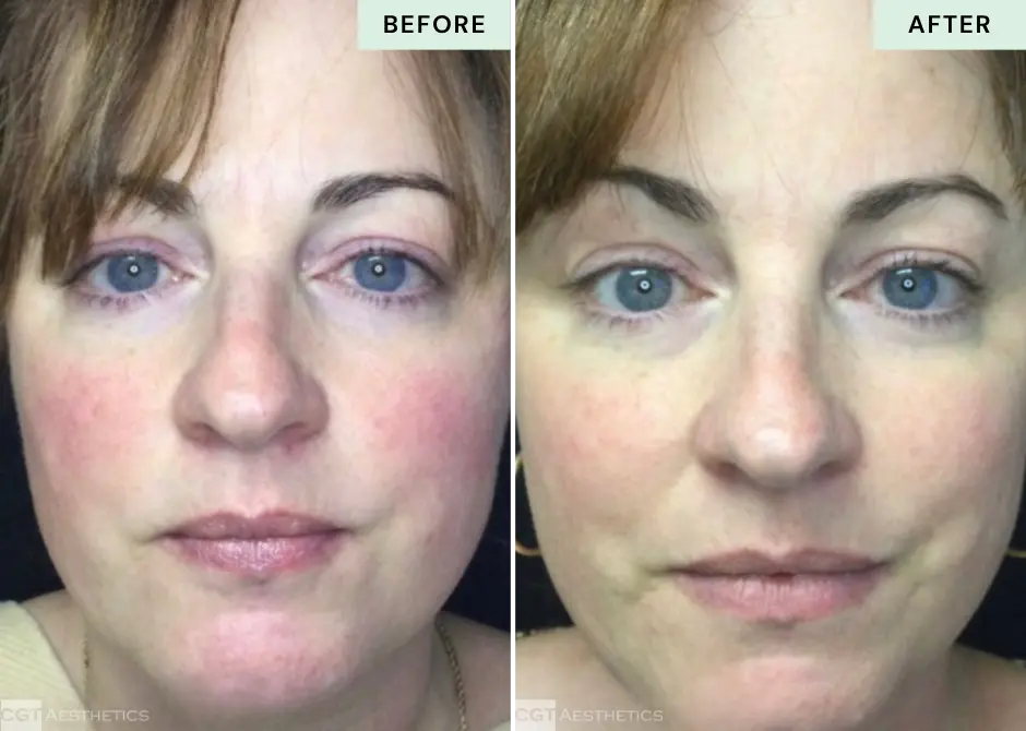 IPL rosacea and facial redness before and after at CGT Aesthetics in Evergreen Park and Westmont