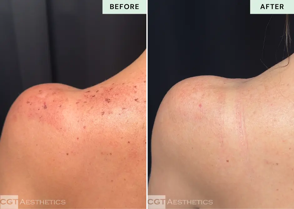 IPL shoulders before and after at CGT Aesthetics in Evergreen Park and Westmont