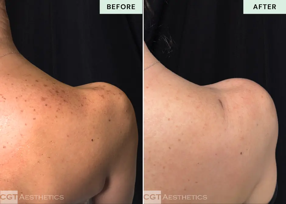 IPL shoulders before and after at CGT Aesthetics in Evergreen Park and Westmont