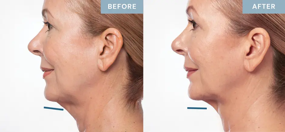 kybella-double-chin-before-after-female-patient-1