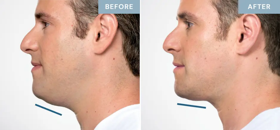 kybella-double-chin-before-after-male-patient
