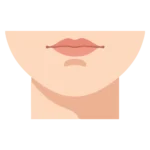 Illustration showing submental fullness beneath the chin that may be treated with Kybella