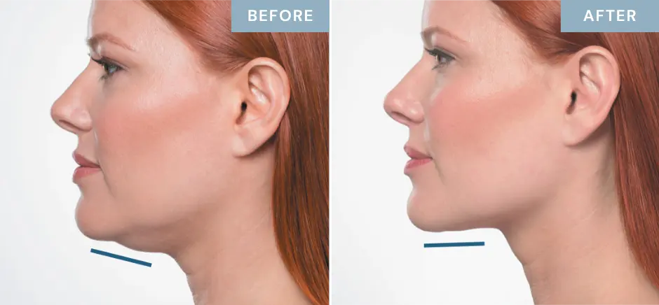 kybella-jawline-contouring-before-after-female-patient